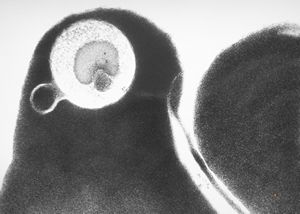 M,49y. | blood - dyserythropoetic anemia M,49y. | blood - dyserythropoetic anemia